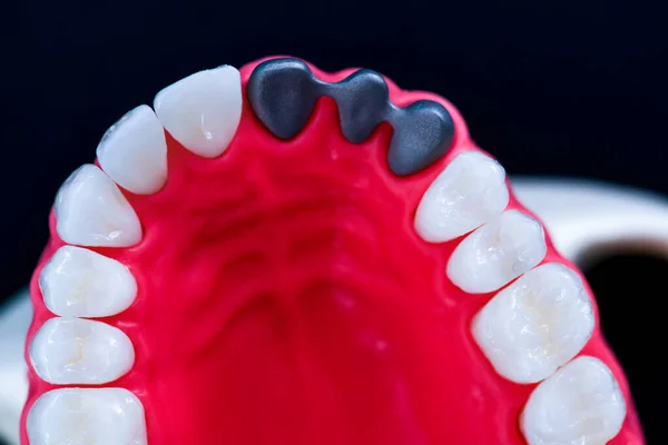 Tooth implant and crown installation process — Stock Photo, Image