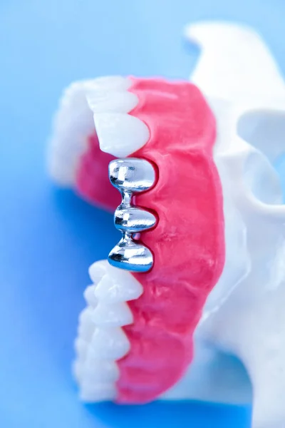 Proceso de instalación de implantes dentales y corona —  Fotos de Stock