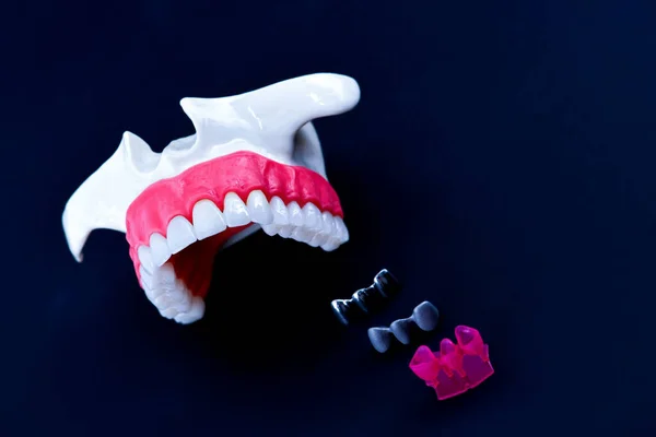 Zahnimplantat und Kroneneinbau — Stockfoto