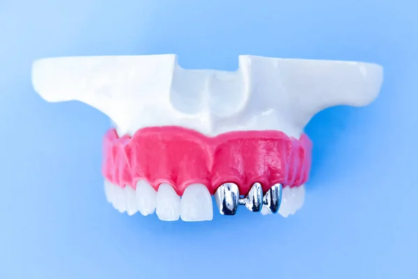 Tooth implant and crown installation process — Stock Photo, Image