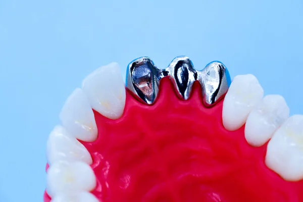 Proces instalace zubního implantátu a koruny — Stock fotografie