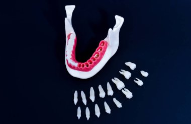 Diş implantı ve taç yerleştirme işlemi