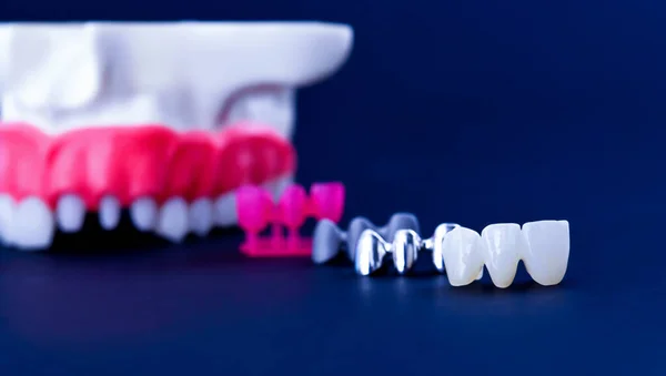 Процес встановлення зубів та коронки — стокове фото