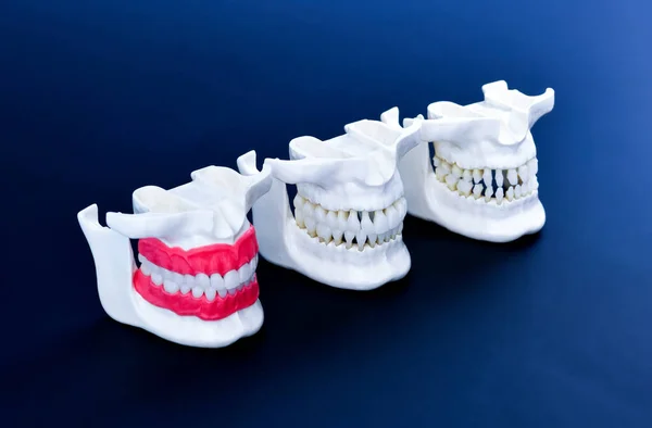 Menselijke kaken met tanden en tandvlees anatomie modellen — Stockfoto