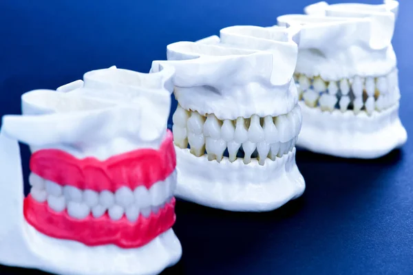 Anatomische Modelle menschlicher Kiefer mit Zähnen und Zahnfleisch — Stockfoto