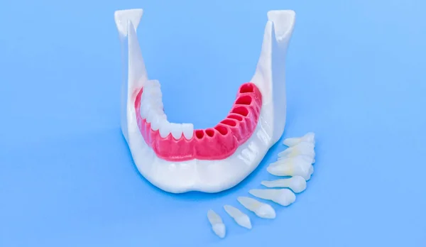 Процесс установки зубного импланта и коронки — стоковое фото