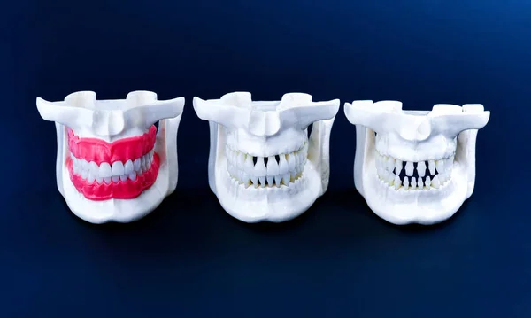 Mascelle umane con denti e gengive modelli anatomici — Foto Stock