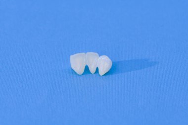 Metalsiz seramik diş kaplamaları