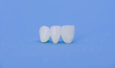 Metalsiz seramik diş kaplamaları