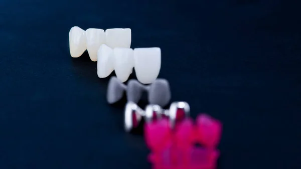 Farklı diş kaplamaları — Stok fotoğraf