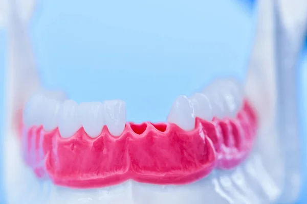 Tooth implant and crown installation process — Stock Photo, Image