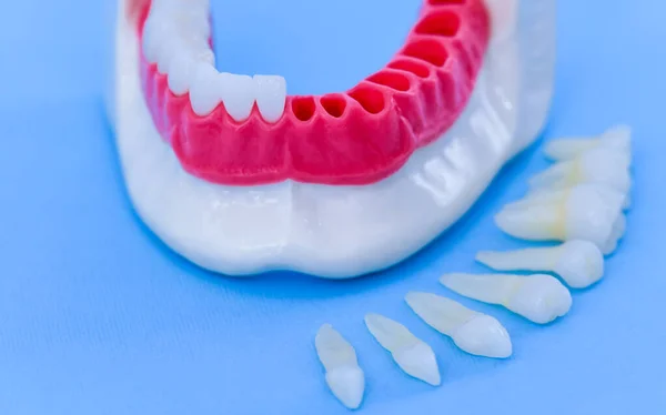 Процесс установки зубного импланта и коронки — стоковое фото