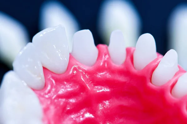 Tooth implant and crown installation process — Stock Photo, Image