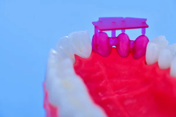 Diş implantı ve taç yerleştirme işlemi — Stok fotoğraf