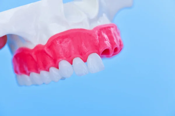 Processus d'installation de l'implant dentaire et de la couronne — Photo