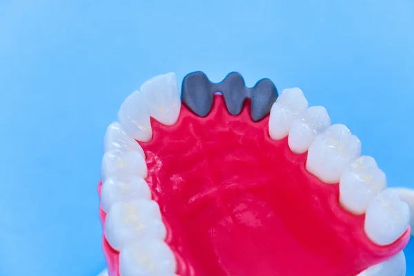 Processo di installazione di impianti dentali e corona — Foto Stock