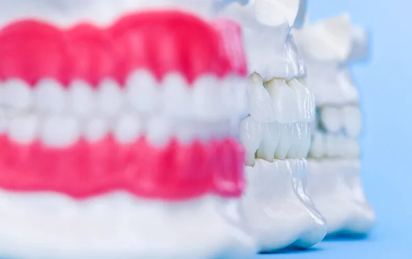 이빨 과 잇몸 해부학 모델을 가진 사람의 턱 — 스톡 사진