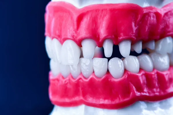 Mandíbula humana con modelo de anatomía de dientes y encías — Foto de Stock