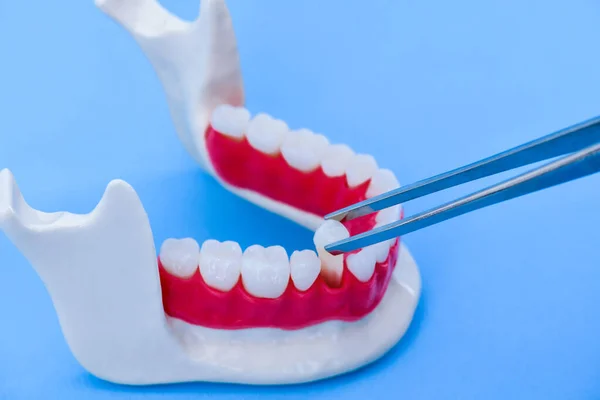Pinzas que sacan el diente del modelo de mandíbula inferior —  Fotos de Stock