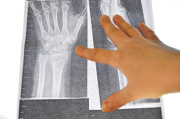 X-ray picture of a broken hand