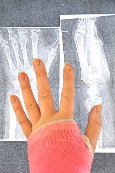 Hand Cast Holding Ray Picture Stock Photo