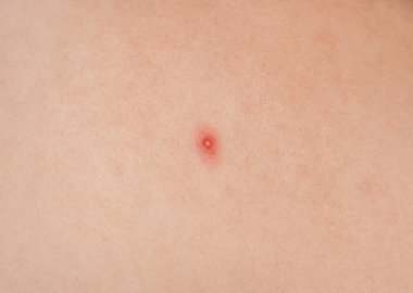 Ten yakın çekim üzerinde büyük kırmızı kabartılar. Güzellik ve Cilt Bakımı.