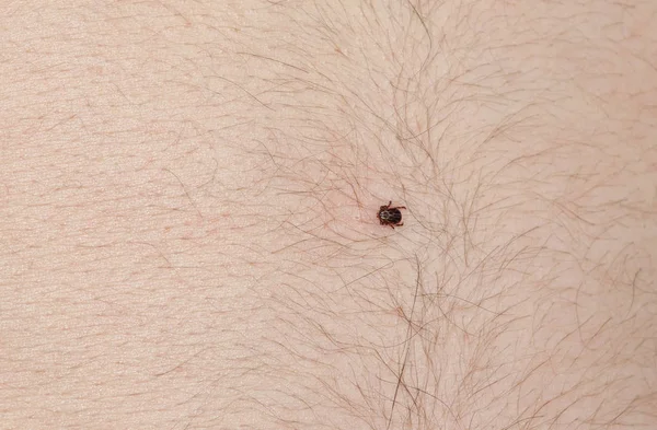 The tick of Ixodidae sits on the belly of a man — Stock Photo, Image