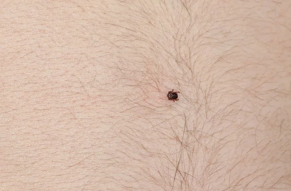 O carrapato de Ixodidae fica na barriga de um homem — Fotografia de Stock