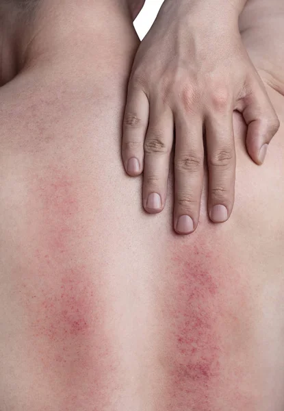 Gore e vermelhidão nas costas do homem ao longo da coluna vertebral, como resultado de lesão . — Fotografia de Stock