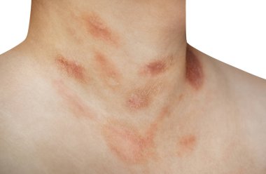 Pityriasis rosea hastalığı göğüs ve boyun üzerinde olan bir kişi