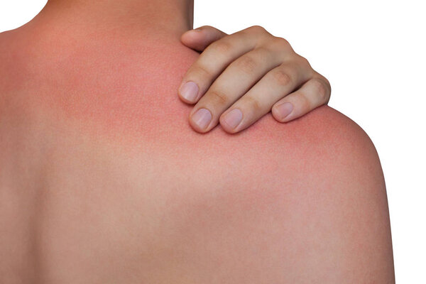 A man with reddened, itchy skin after sunburn on white isolated background