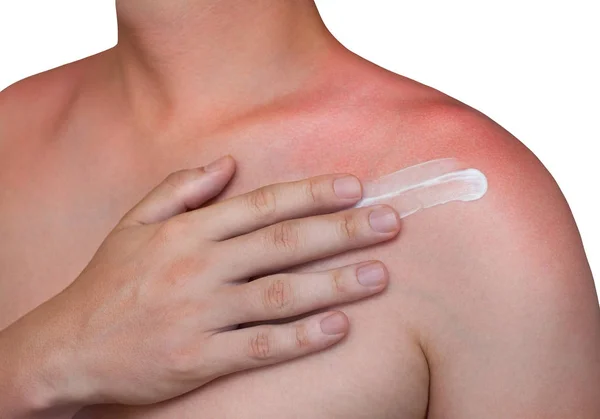 Мужчина с покрасневшей, зудящей кожей после солнечных ожогов наносит крем на плечо — стоковое фото