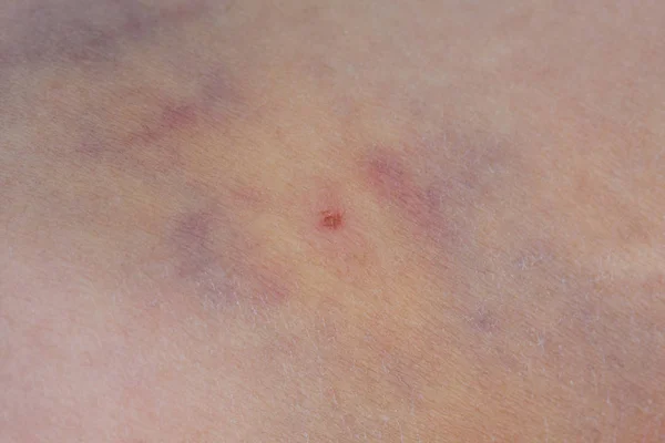 Bruise Skin Person Close — Stock Photo, Image