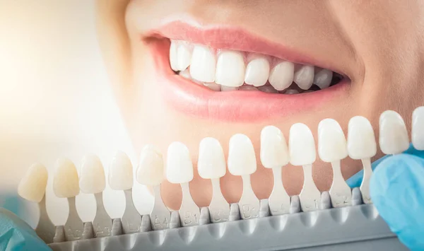 Bel Sorriso Denti Bianchi Una Giovane Donna Abbinare Tonalità Degli — Foto Stock