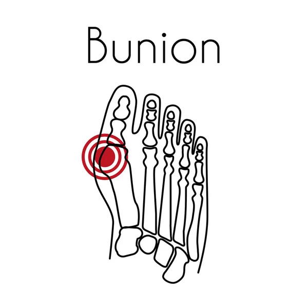 Bunion in illustrazione vettoriale piede — Vettoriale Stock