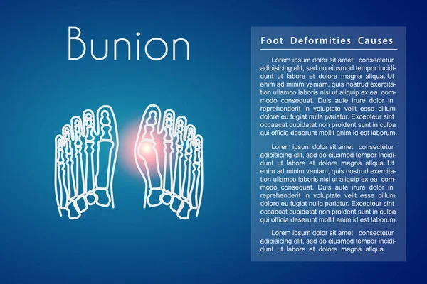 Bunion in voet vector achtergrond — Stockvector