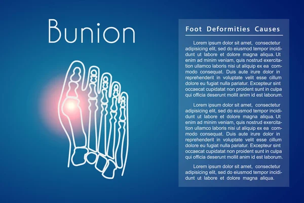 Bunion in voet vector achtergrond — Stockvector