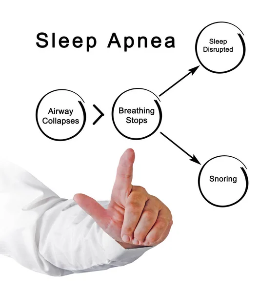 Diagrama de la apnea del sueño — Foto de Stock
