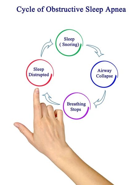 Cycle Obstructive Sleep Apnea — Stock Photo, Image