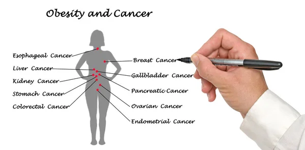 Conexão entre obesidade e câncer — Fotografia de Stock