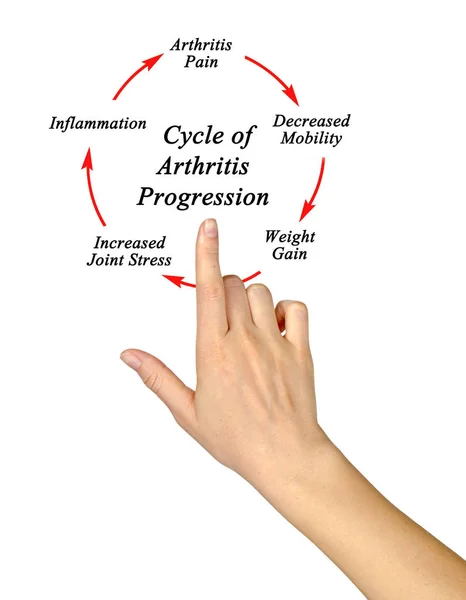 Шаги в цикле развития артрита — стоковое фото
