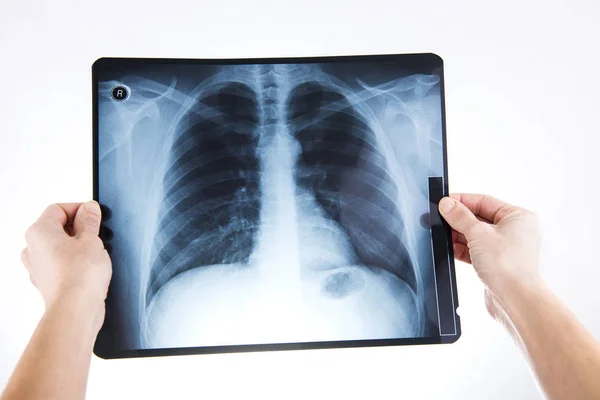 X-ray van longen — Stockfoto