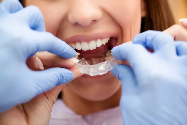 Close-up of a Invisible Braces — Stock Photo, Image