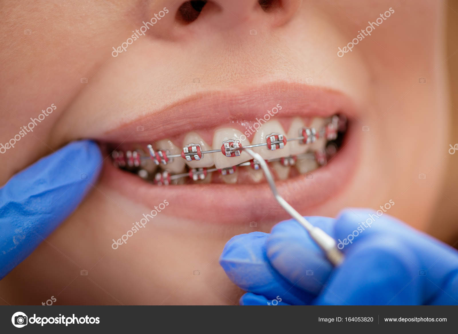 Dentist checking bracket Stock Photo by ©MilanMarkovic 164053820