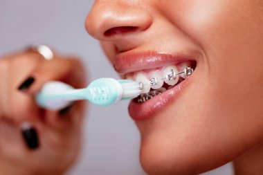 Close-up of a smiling woman face with braces on white teeth and toothbrush.  clipart