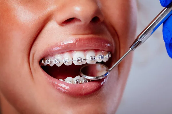 Närbild Tandläkare Kontrollera Hängslen Med Dental Spegel Den Kvinnliga Tålmodig — Stockfoto