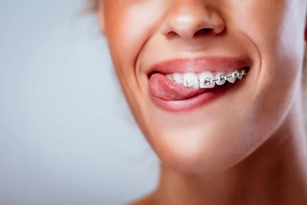 完璧な歯で舌をかむブレースを有する女の子の笑顔のクローズ アップ — ストック写真