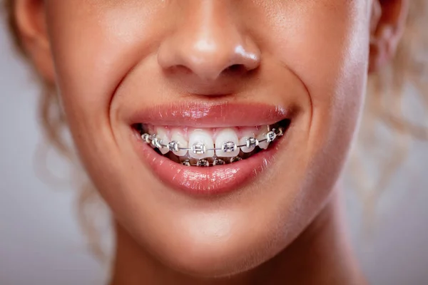 Крупный План Женщины Белые Зубы Брекетами Улыбкой — стоковое фото