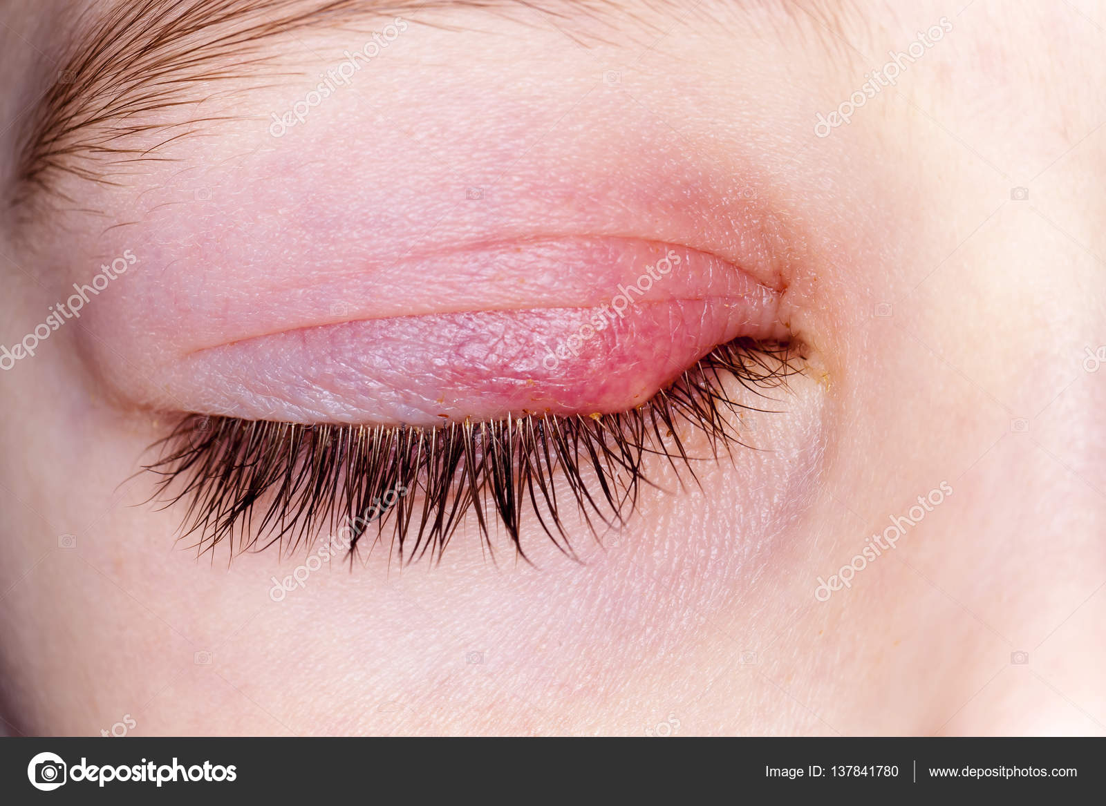 Closed Kid Eye With Sty Stock Photo By C Omstudio