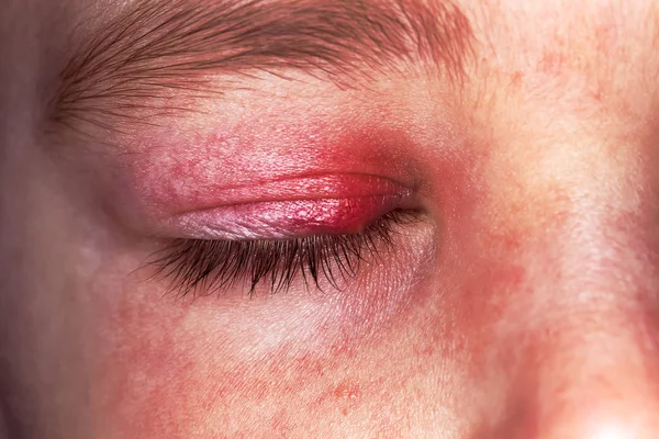 Stye bambino occhio rosso pelle orzo batteri virus — Foto Stock